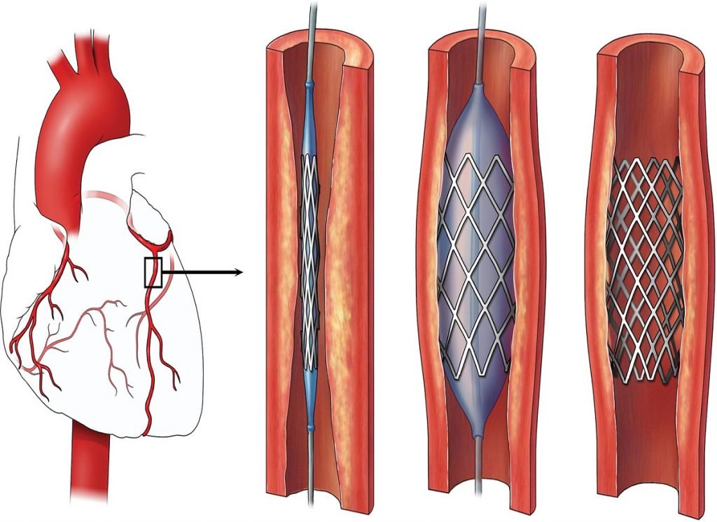 Angioplasty Image
