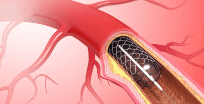 dr amar upadhyay angioplasty