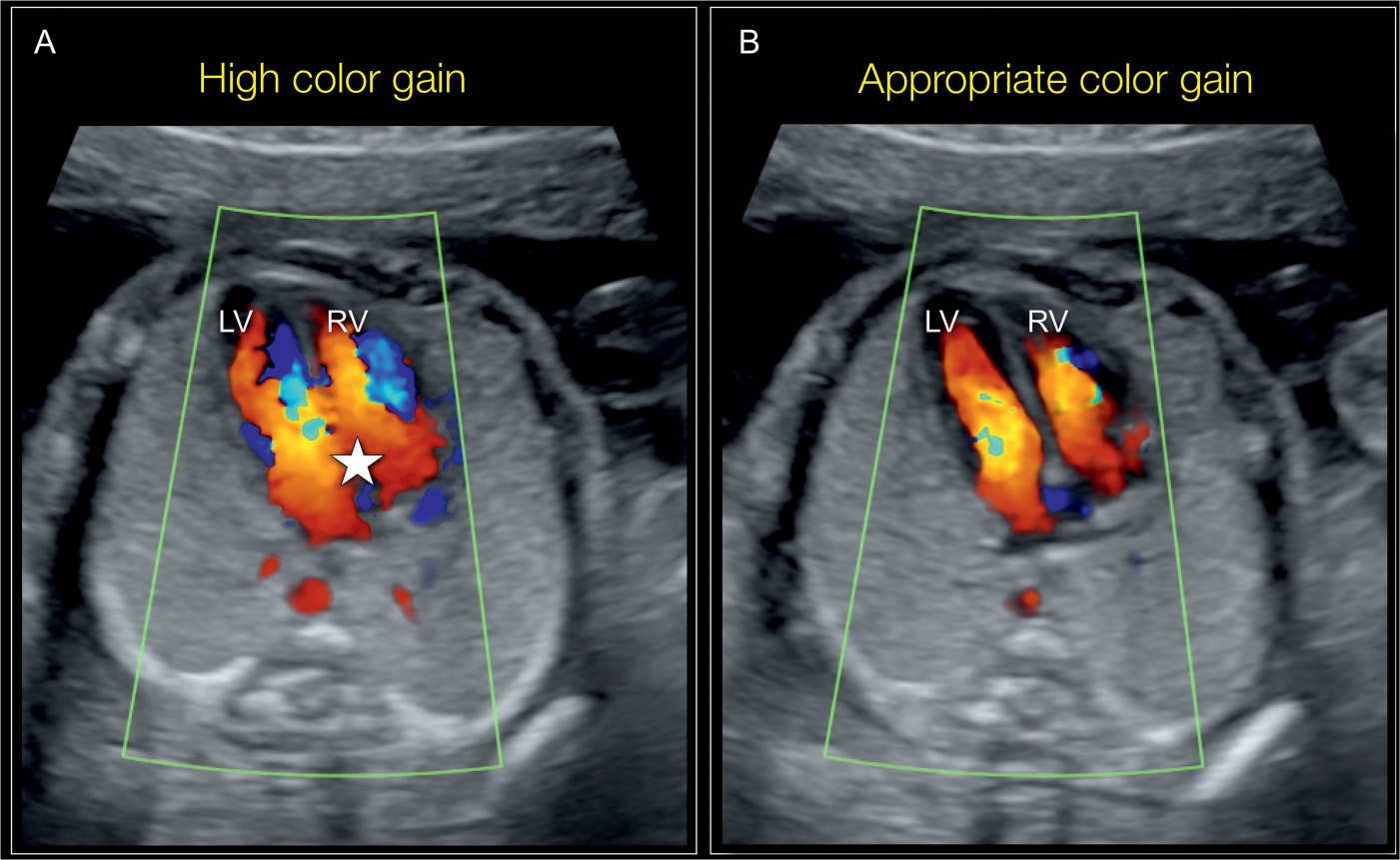 Fetal Echo Image